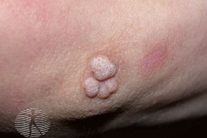 pinnacleskin.com /conditions/warts Carousel 1 Image 1