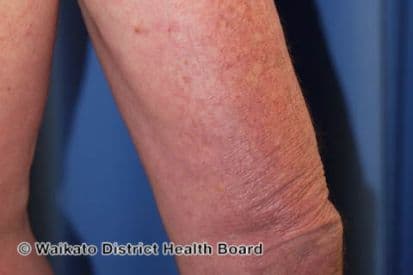 rash-on-arm