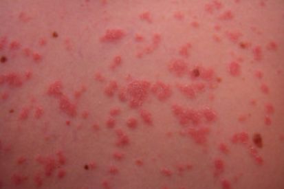 Psoriasis1